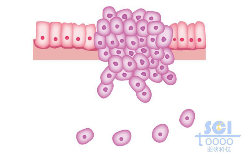 有癌細(xì)胞的腸上皮細(xì)胞