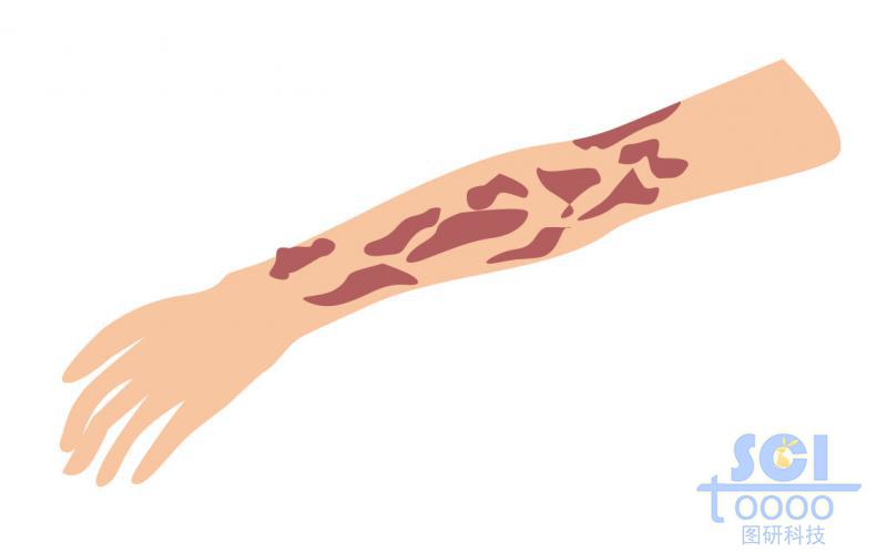 手臂及手臂紅斑示意圖