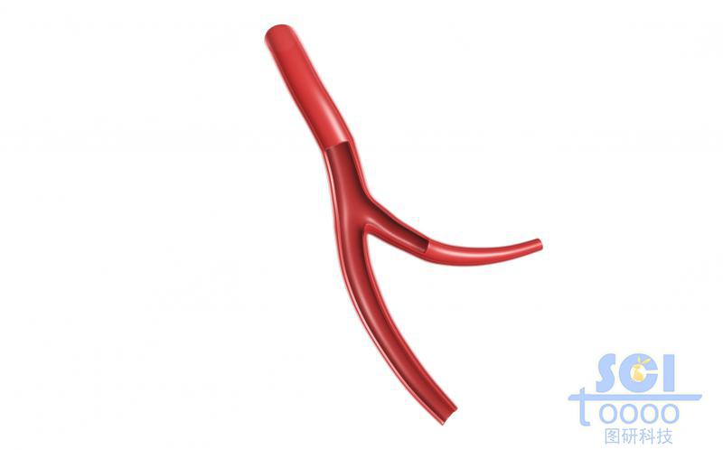 前段帶分支帶切口的血管