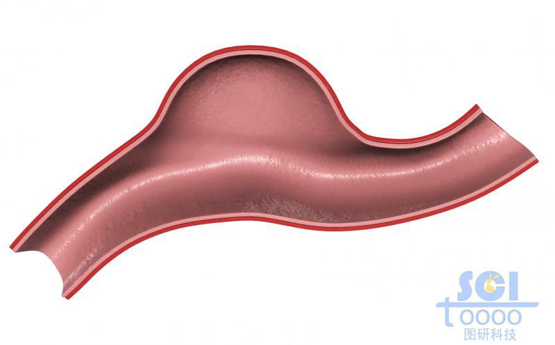 帶腫瘤結(jié)構(gòu)的半剖面的血管